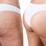 SCONFIGGI LA CELLULITE