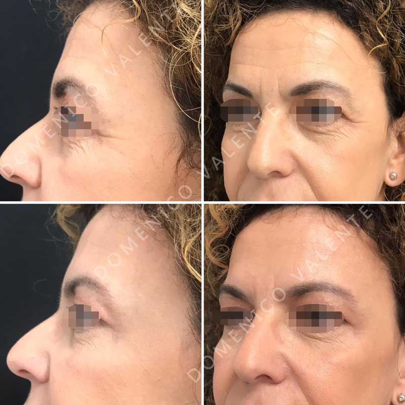 botox-prima-e-dopo-istituto-idf-firenze-11